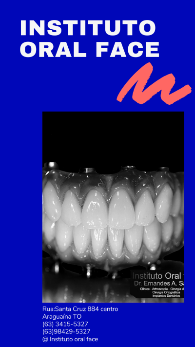 Implantes dentários