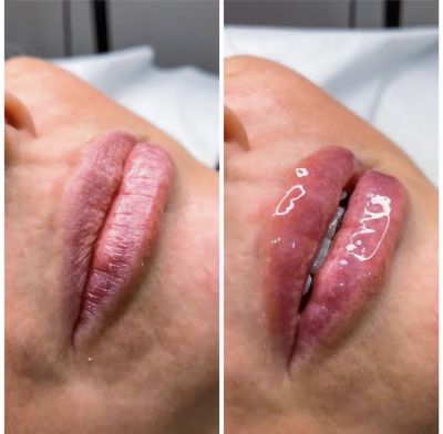Dermaglos Lips