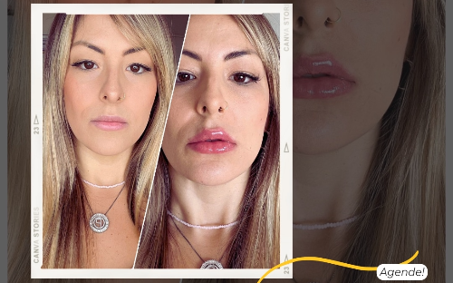 Preenchimento Labial