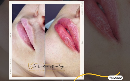 Preenchimento Labial