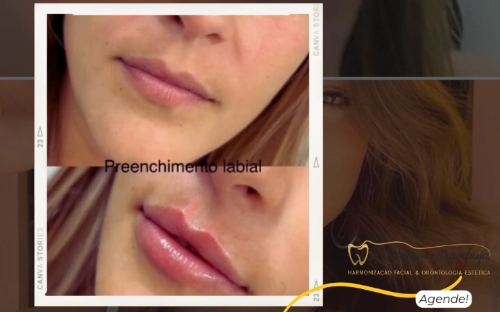 Preenchimento Labial
