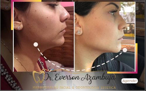 Lipo de Papada Enzimática