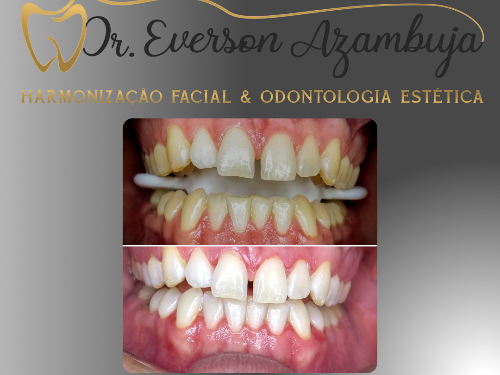 Clareamento Dental Caseiro
