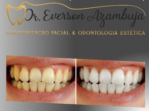 Clareamento Dental Caseiro