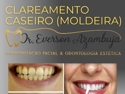 Clareamento Dental Caseiro