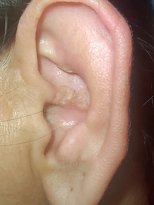 Auriculoterapia neurofisiológica