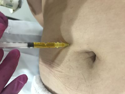Intradermoterapia - Enzimas