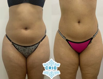 Harmonização Corporal Feminina