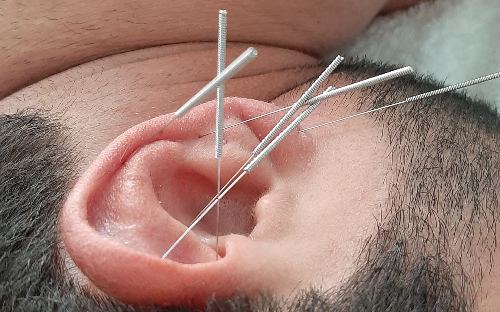 Acupuntura