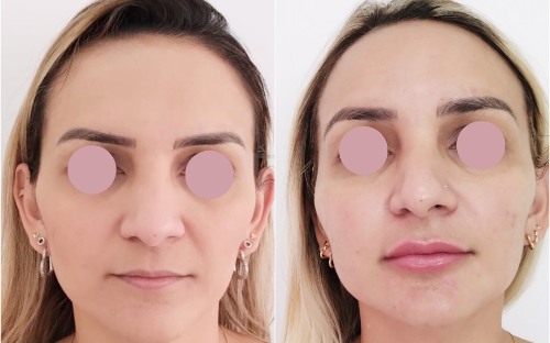 Bioestimulador de colágeno Face