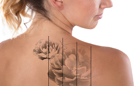 Remoção de Tatuagem a laser