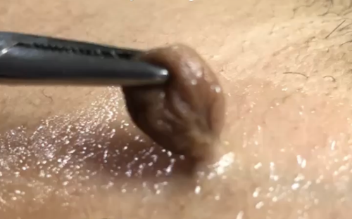 Remoção de sinais - Jato de plasma