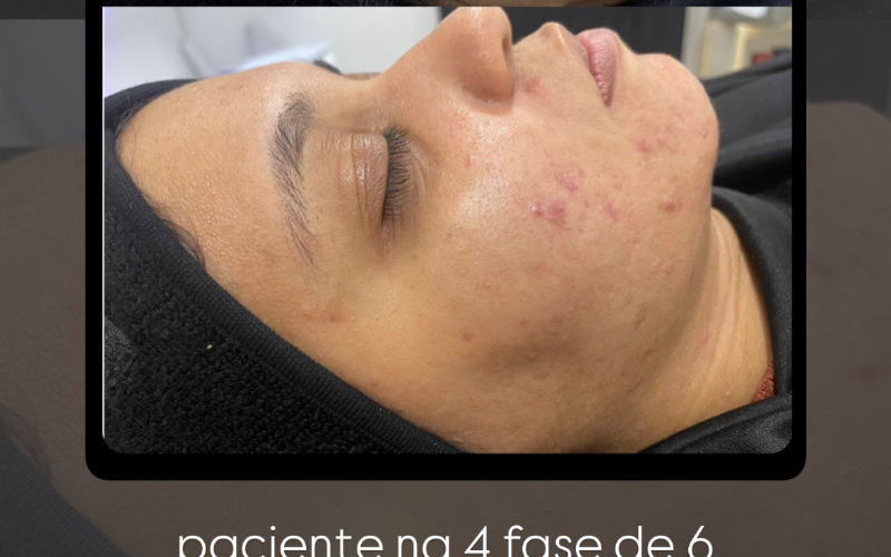 CONSULTA MODULAÇÃO CUTÂNEA