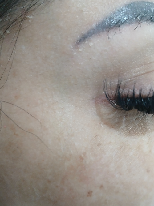 Botox