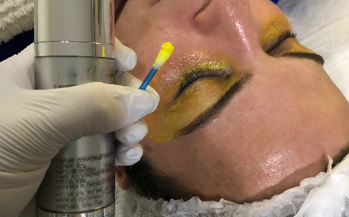 Peeling Químico