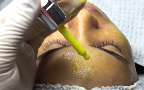 Peeling Químico
