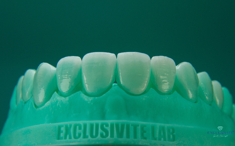Lentes de Contato Dental