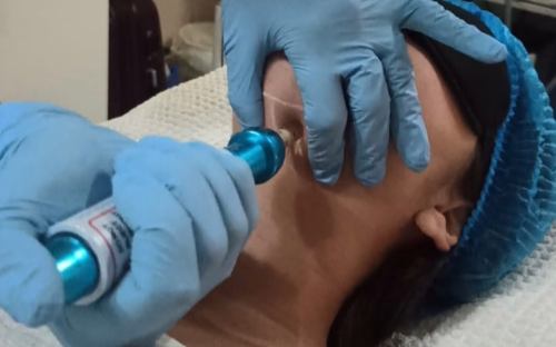 Lipo de papada