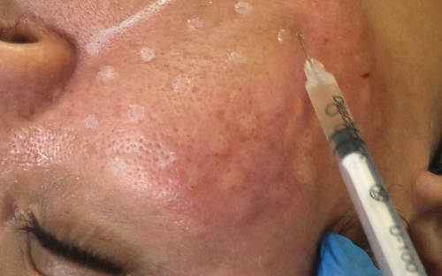 SKINBOOSTER