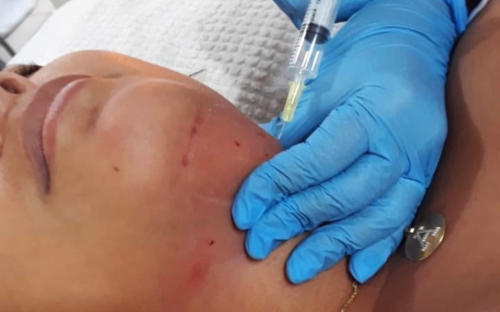 Lipo de papada