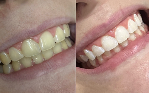 Clareamento Dental