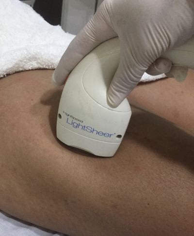 Epilação a Laser