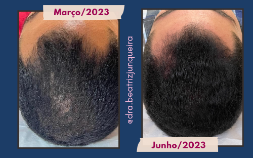 Tratamento para Queda e Alopecias