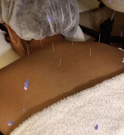 Dry Needling