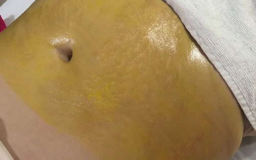 Peeling Químico