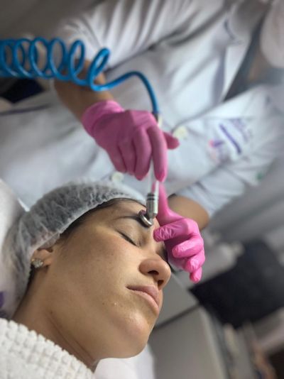 Microdermobrasão (peeling de diamante)