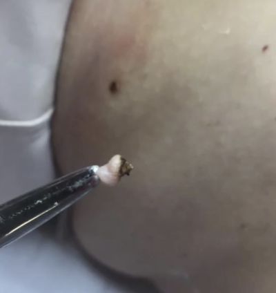 Remoção de sinais - Jato de plasma
