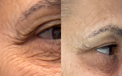 Botox