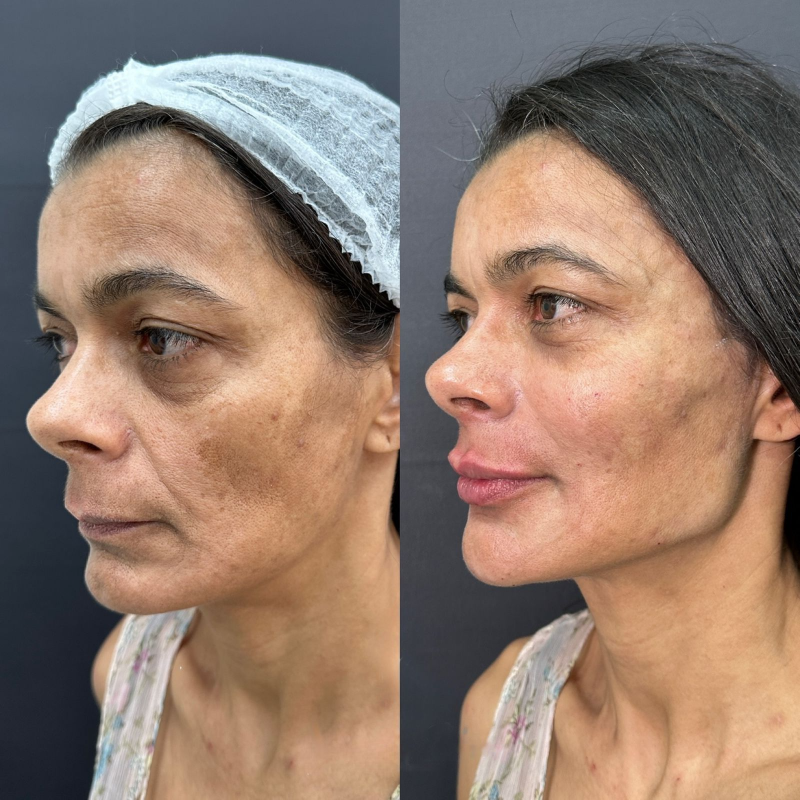 Harmonização Facial