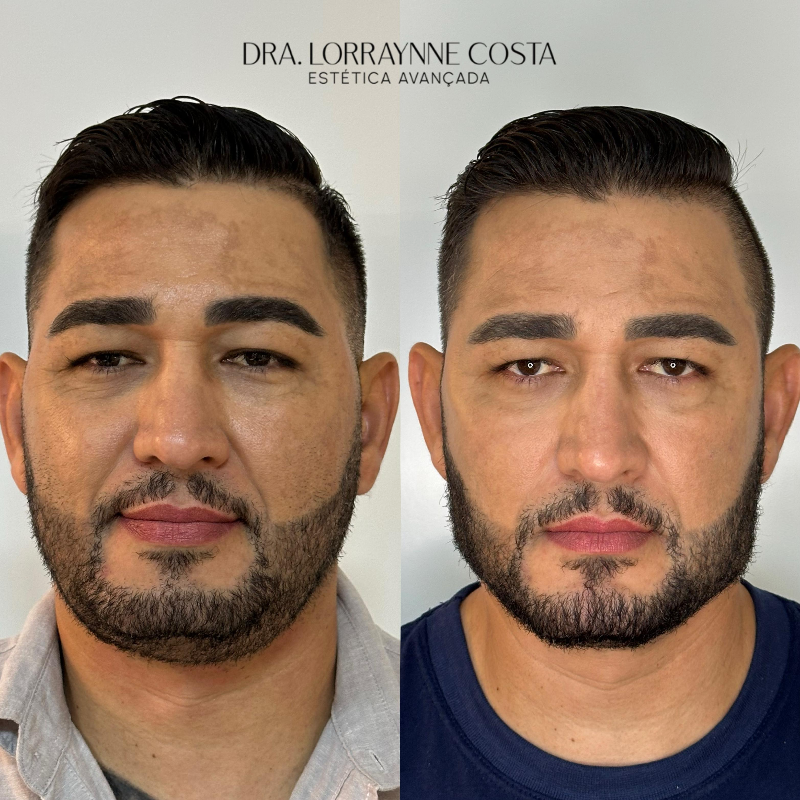 Harmonização Facial