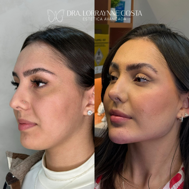 Harmonização Facial