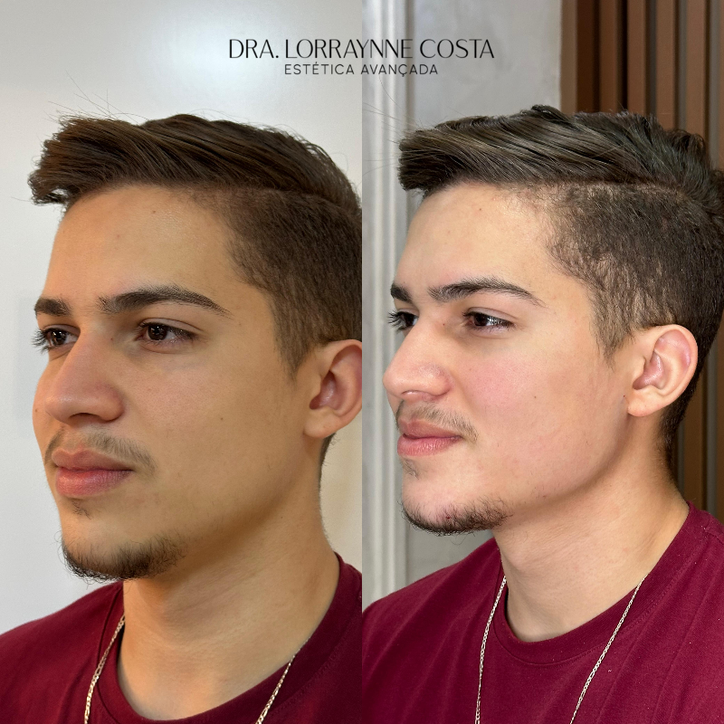 Harmonização Facial