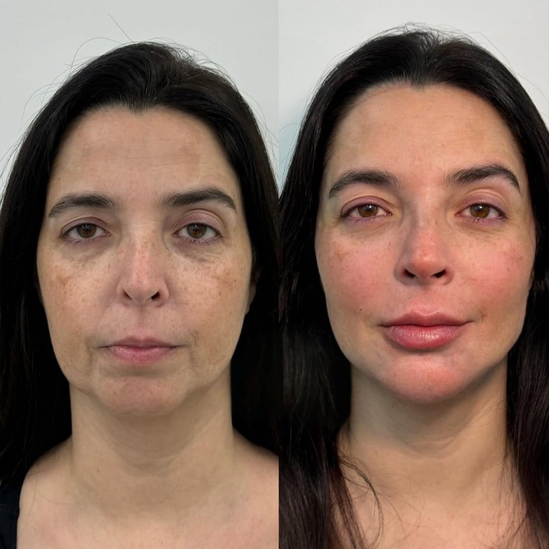 Harmonização Facial