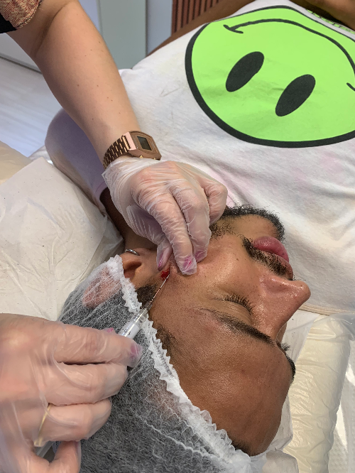 Bioestimulador de colágeno Radiesse