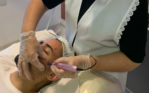 Microagulhamento Facial