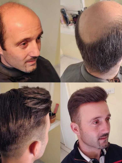 Próteses capilar masculina