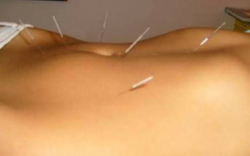 Acupuntura