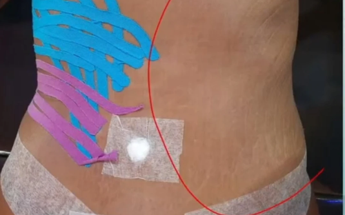 Kinesio tape