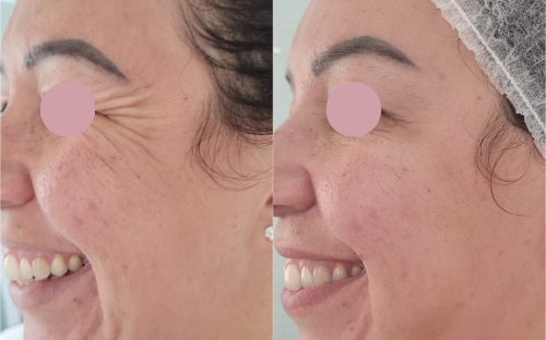 Botox