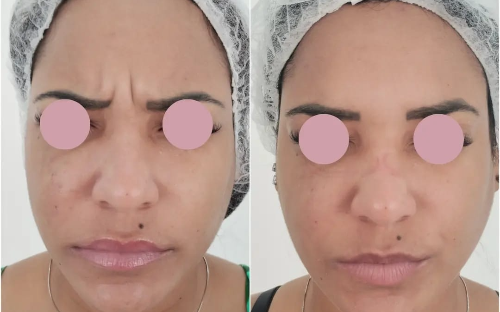 Botox