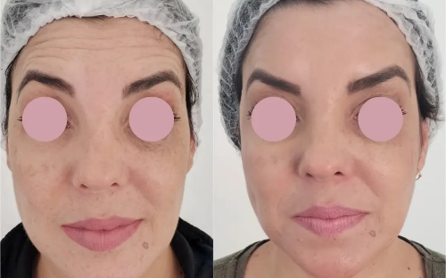 Botox