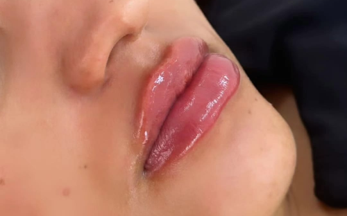 Preenchimento Labial