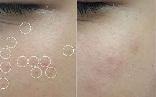 Limpeza de pele