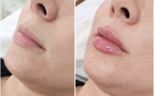 Preenchimento Labial