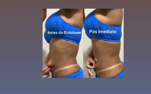 Endolaser/Endolift