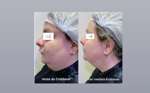 Endolaser/Endolift